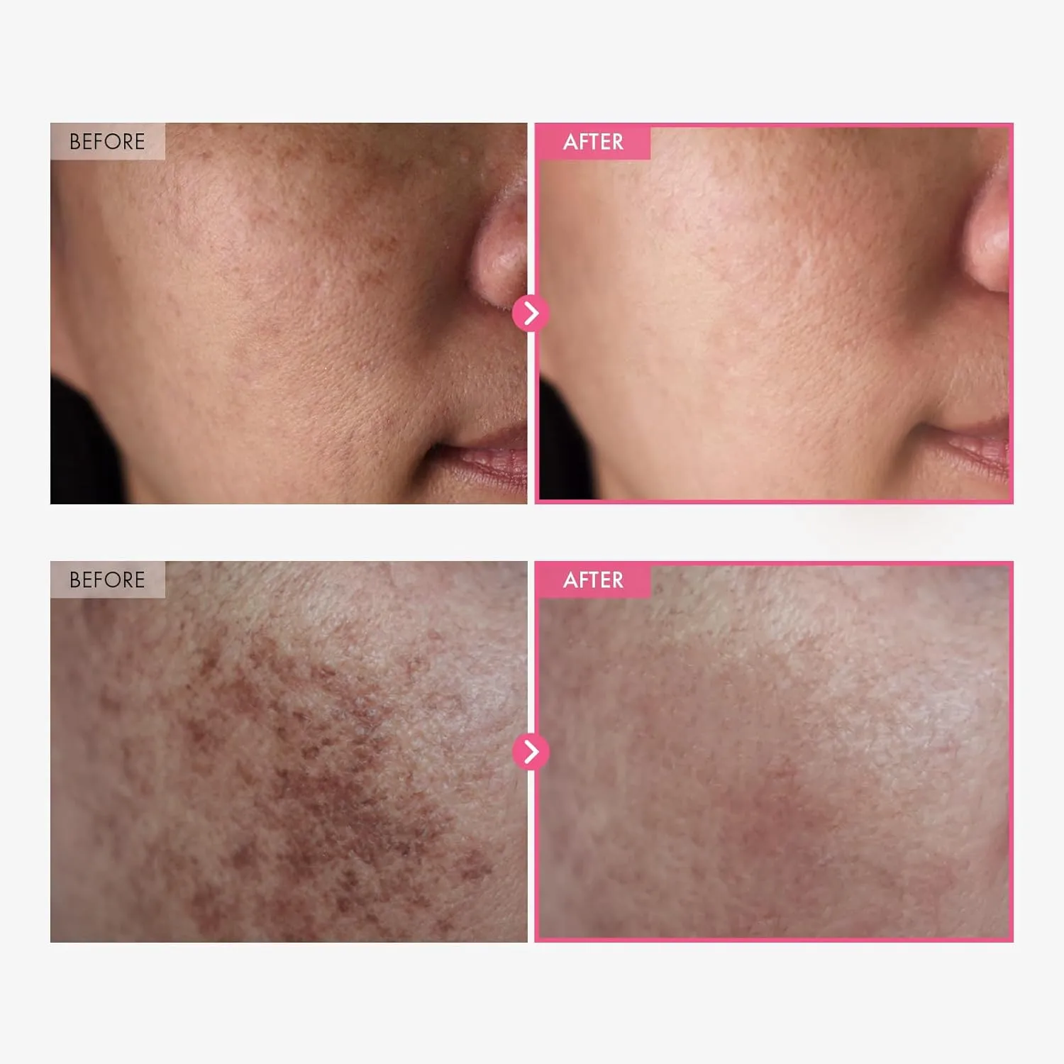 Arbutin 7%   Tranexamic Acid 4% Cream, 70,000ppm Arbutin, 40,000ppm TXA, Niacinamide, Glutathione, Dark Spots, Freckle, Blemishes, Pigmentation, Korean Skin Care, 50ml, 1.69 fl.oz.